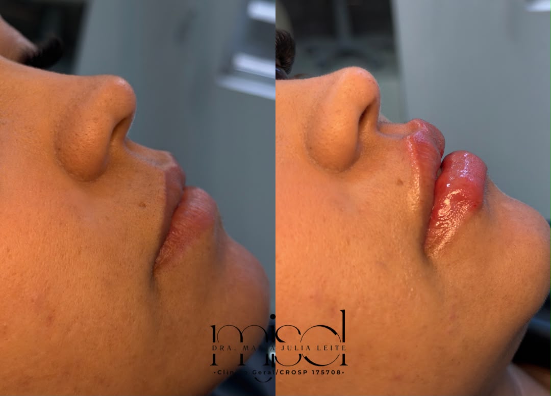 Resultado 3 — antes e depois